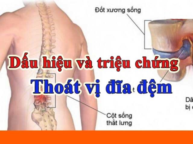 DẤU HIỆU TRIỆU CHỨNG THOÁT VỊ ĐĨA ĐỆM