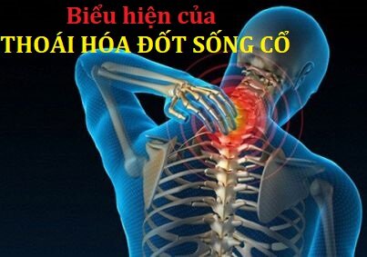 biểu hiện thoái hóa đốt sống cổ