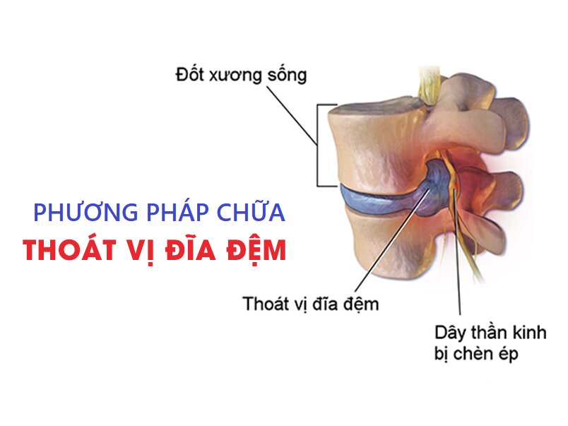 PHƯƠNG PHÁP ĐIỀU TRỊ THOÁT VỊ ĐĨA ĐỆM