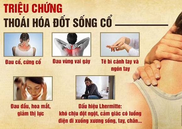 Triệu chứng thoái hóa đốt sống cổ