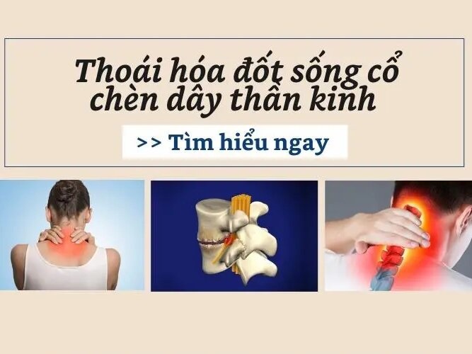 Thoái hóa đốt sống cổ chèn ép dây thần kinh nào?