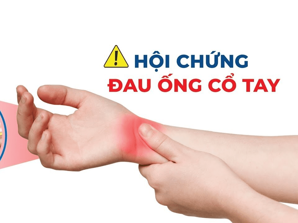 Hội chứng ống cổ tay - Hãy coi chừng kẻo muộn