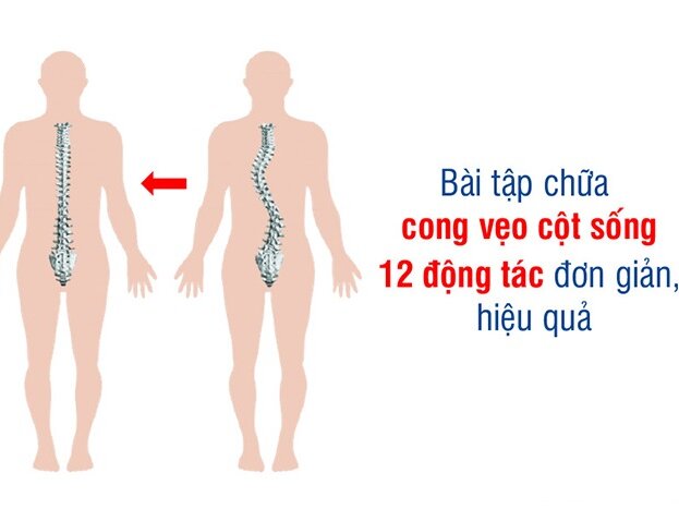 12 BÀI TẬP CHỮA CONG VẸO CỘT SỐNG ĐƠN GIẢN HIỆU QUẢ