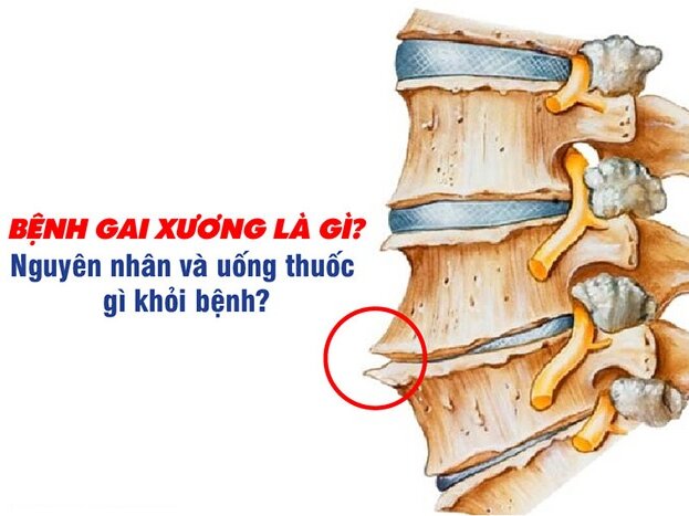 Bệnh gai xương là gì? Nguyên nhân và uống thuốc gì khỏi bệnh?