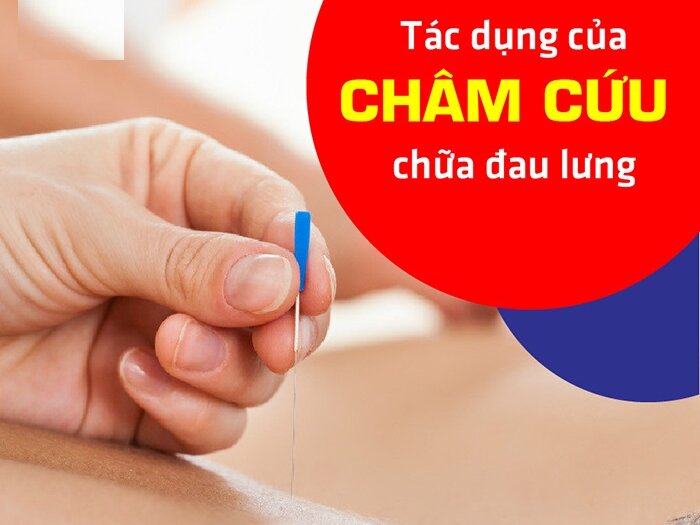 Top 5+ phương pháp châm cứu chữa đau lưng