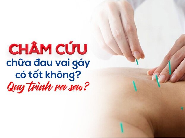 Châm cứu chữa đau vai gáy có tốt không? Quy trình ra sao?