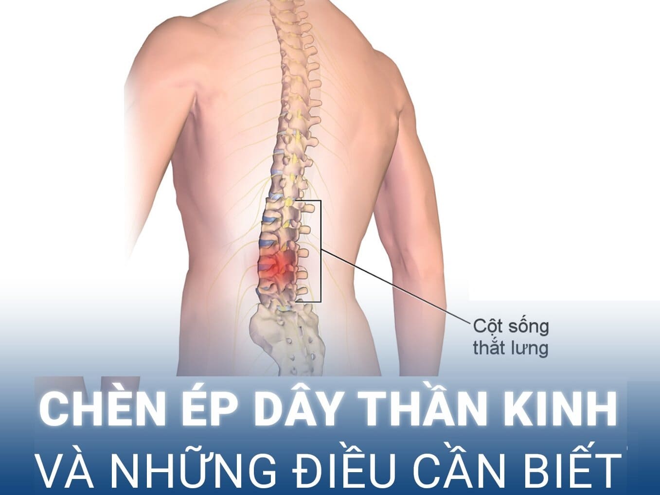 Hội chứng chèn ép dây thần kinh: Triệu chứng, nguyên nhân và cách điều trị