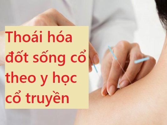 Thoái hóa đốt sống cổ theo y học cổ truyền