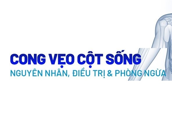 Vẹo cột sống: Nguyên nhân triệu chứng và phương pháp điều trị hiệu quả