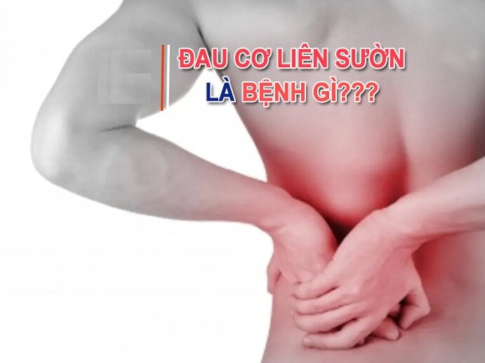 Đau cơ liên sườn là gì? Nguyên nhân và cách giảm đau hiệu quả