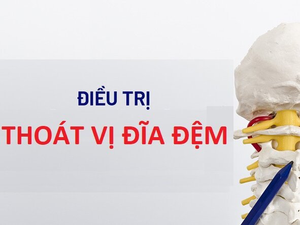 ĐIỀU TRỊ THOÁT VỊ ĐĨA ĐỆM