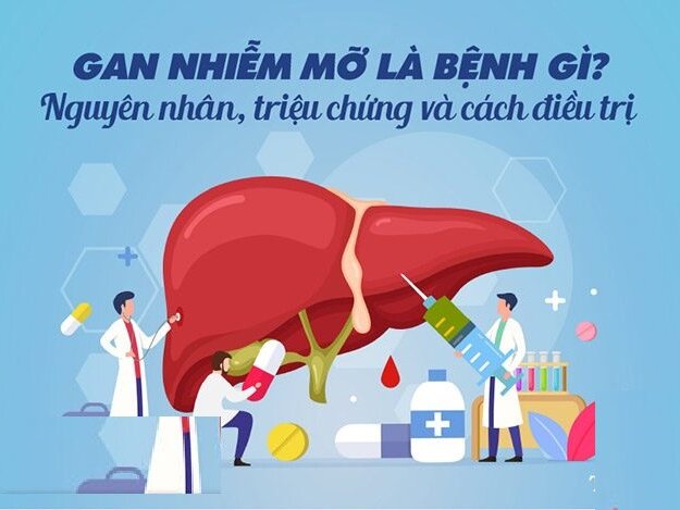 Gan nhiễm mỡ là bệnh gì? Nguyên nhân, triệu chứng và cách điều trị