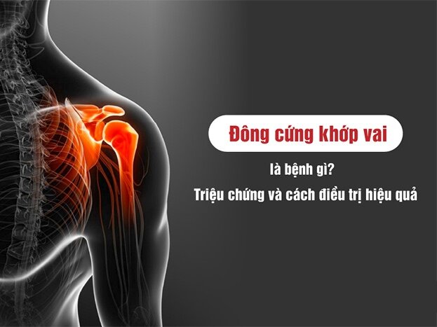 Đông cứng khớp vai là bệnh gì? Triệu chứng và cách điều trị hiệu quả