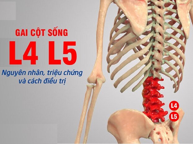 Gai cột sống L4 L5 – Nguyên nhân, triệu chứng và cách điều trị