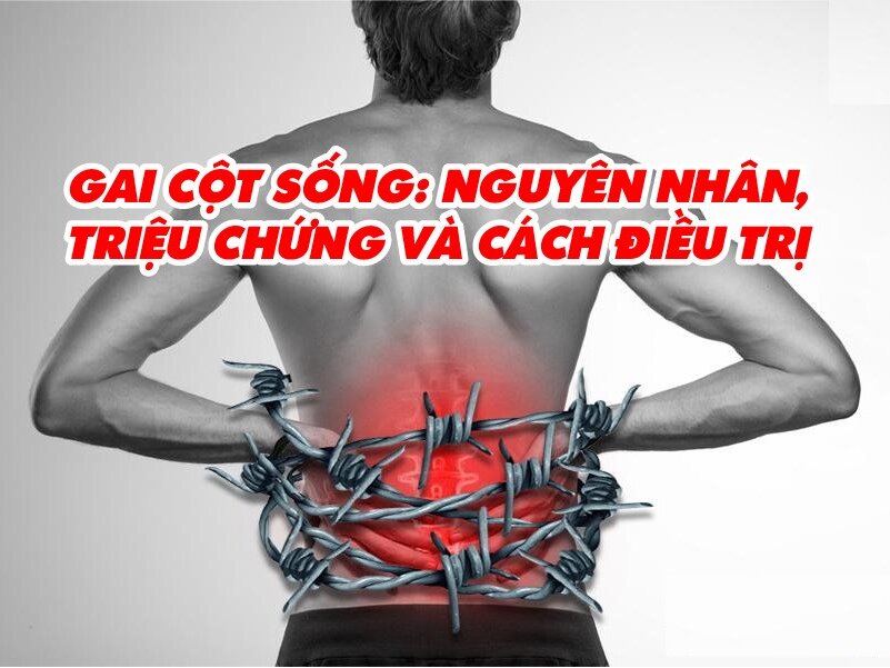 GAI CỘT SỐNG: NGUYÊN NHÂN, DẤU HIỆU VÀ CÁCH ĐIỀU TRỊ