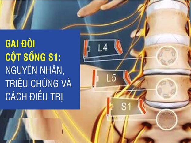 Gai đôi cột sống S1: Nguyên nhân, triệu chứng và cách điều trị