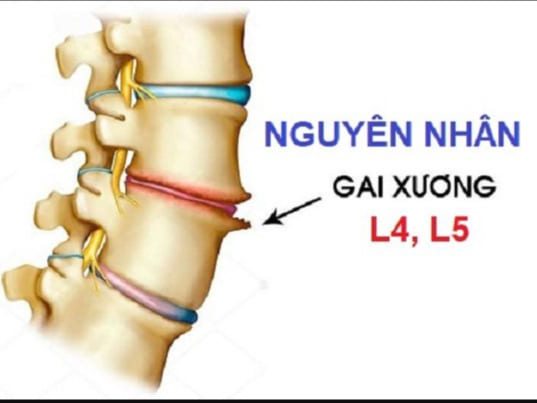 Gai cột sống: Nguyên nhân, triệu chứng, chẩn đoán và điều trị