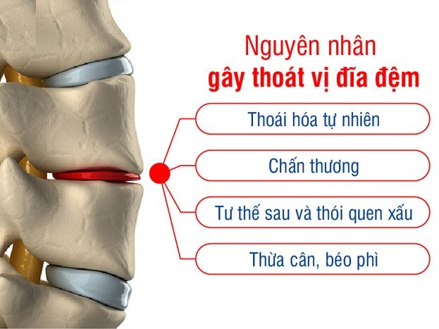 NGUYÊN NHÂN BỊ THOÁT VỊ ĐĨA ĐỆM