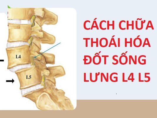 CÁCH CHỮA THOÁI HÓA ĐỐT SỐNG LƯNG L4 L5