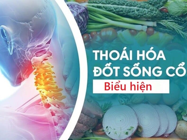 THOÁI HÓA ĐỐT SỐNG CỔ BIỂU HIỆN