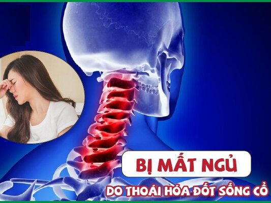 THOÁI HÓA ĐỐT SỐNG CỔ GÂY MẤT NGỦ