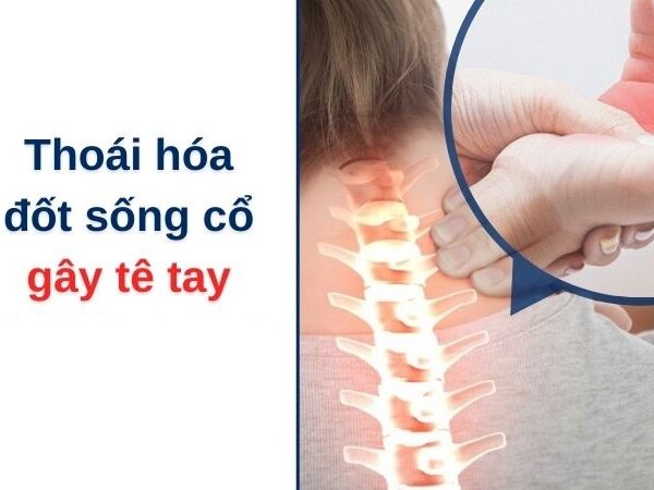 THOÁI HÓA ĐỐT SỐNG CỔ BỊ TÊ TAY