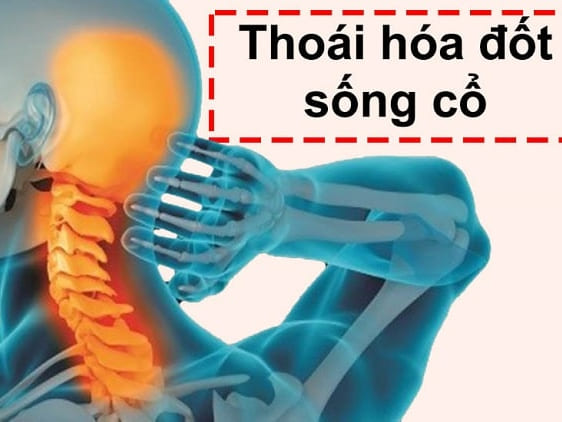 Thoái hóa cột sống cổ và các biến chứng nguy hiểm