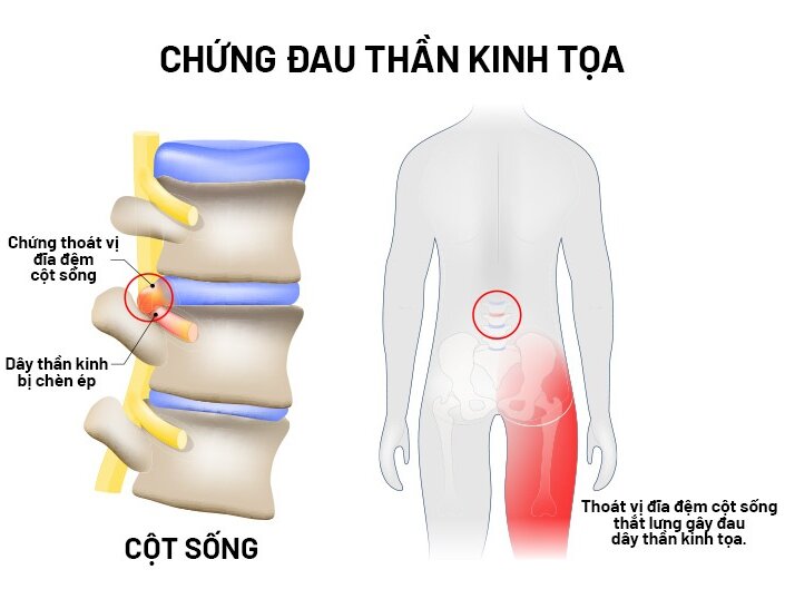 THOÁT VỊ ĐĨA ĐIỂM ĐAU THẦN KINH TỌA