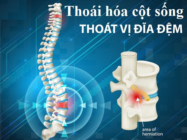 THOÁI HÓA CỘT SỐNG THOÁT VỊ ĐĨA ĐÊM