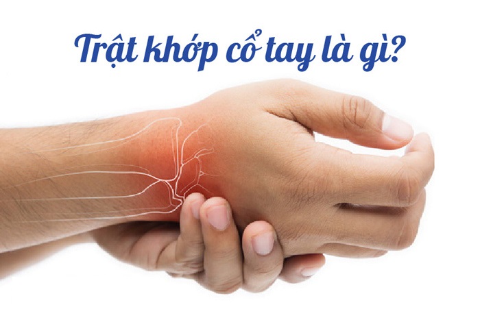 Trật khớp cổ tay: Triệu chứng, nguyên nhân và cách điều trị