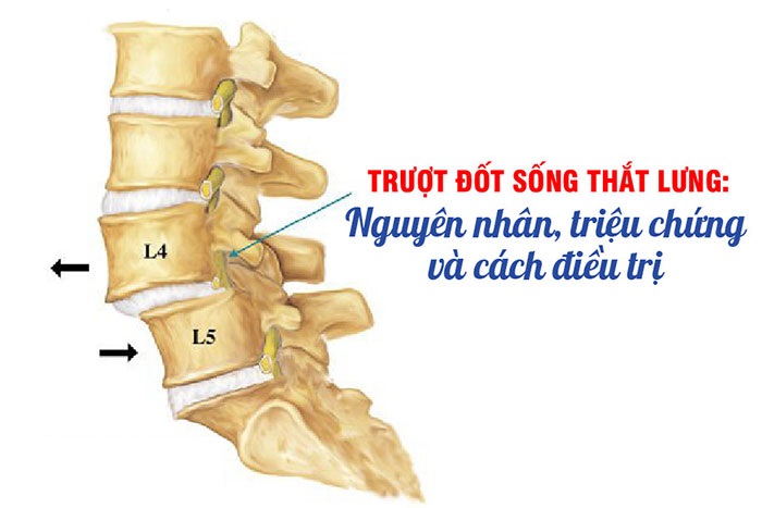 Trượt đốt sống thắt lưng: Nguyên nhân, triệu chứng và cách điều trị