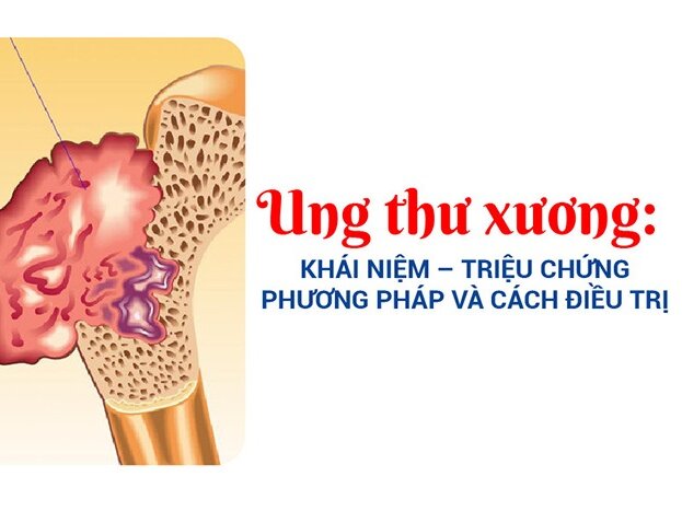 Ung thư xương là gì? Nguyên nhân, triệu chứng, phương pháp điều trị