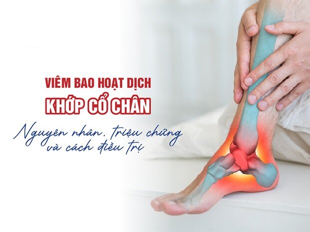 Viêm bao hoạt dịch khớp cổ chân: Nguyên nhân, triệu chứng, cách điều trị