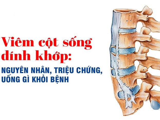 Viêm cột sống dính khớp: Nguyên nhân, triệu chứng, uống gì khỏi bệnh