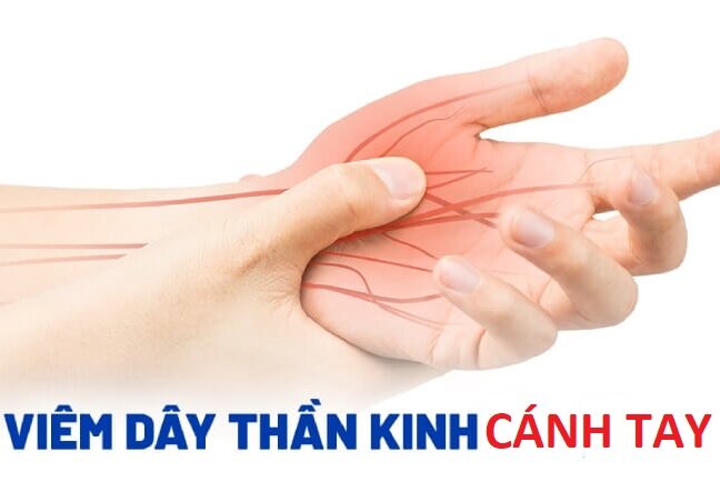 Viêm dây thần kinh cánh tay nguy hiểm ra sao? Cách chữa tốt nhất