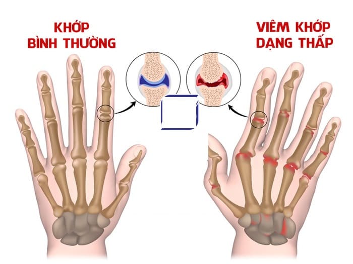 Viêm khớp dạng thấp: Dấu hiệu nhận biết, chẩn đoán & điều trị