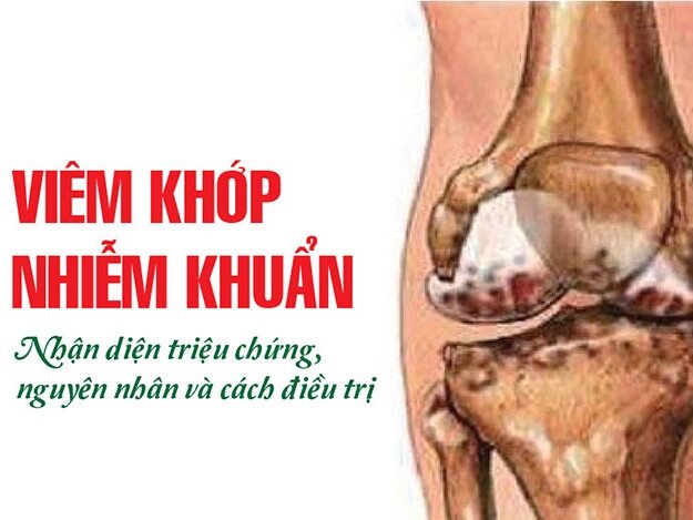 Viêm khớp nhiễm khuẩn Triệu chứng, nguyên nhân và cách điều trị