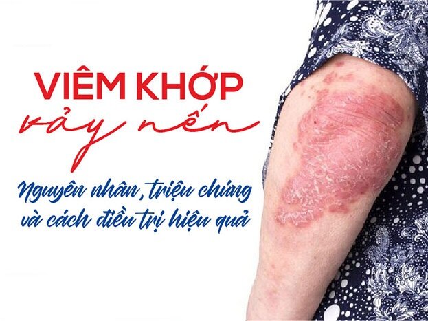 Viêm khớp vảy nến: Nguyên nhân, triệu chứng và cách điều trị hiệu quả