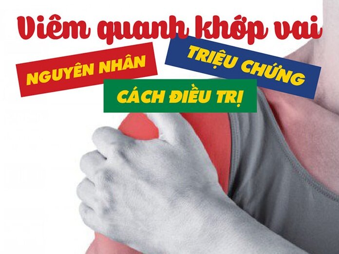 Viêm quanh khớp vai, nguyên nhân, triệu chứng, cách điều trị