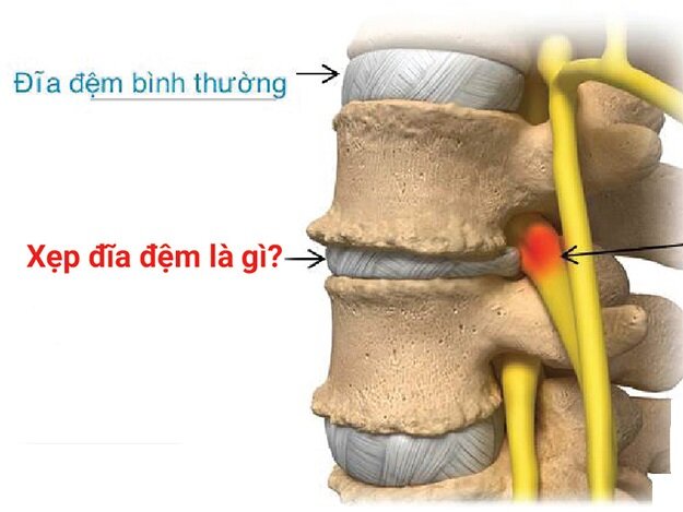 Xẹp đĩa đệm: Nguyên nhân, triệu chứng và cách điều trị