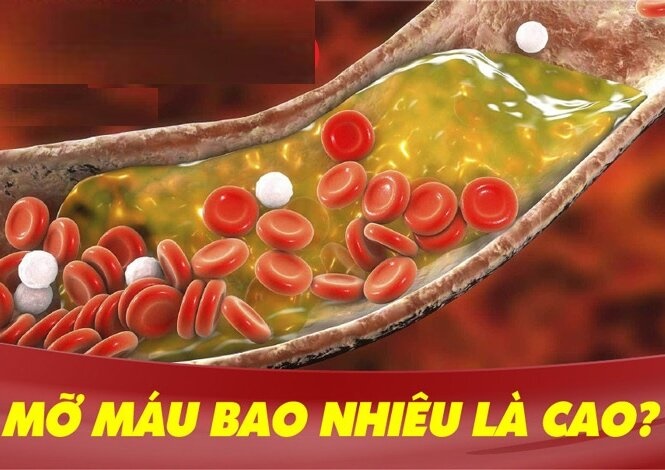 Mỡ máu bao nhiêu là cao? Những lưu ý quan trọng để hạ mỡ máu