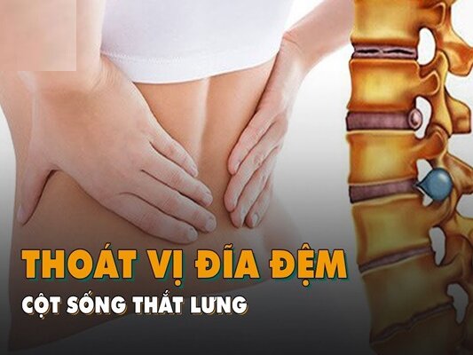 Thoát vị đĩa đệm thắt lưng: Triệu chứng và cách điều trị